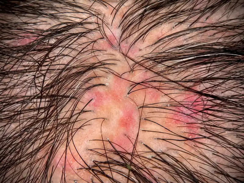 Inflamação interfolicular identificado pelo exame capilar